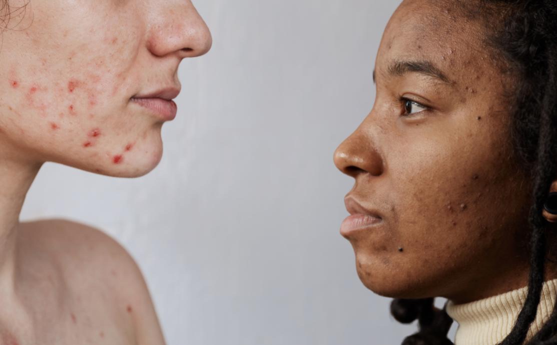 Upcircle Beauty - congested skin