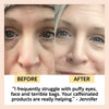 product image-6,Eye Cream customer before and after: puffy eyes and bags